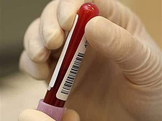 Üre Nitrogen  (BUN)(Kan Üre Azotu) (Serum)