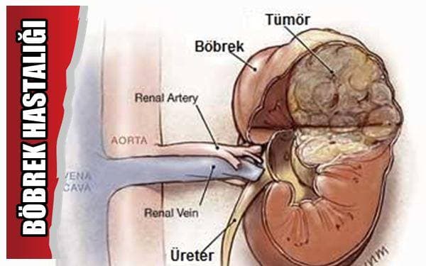 Adrenal Salgı Bezi (Böbrek üstü bezi)