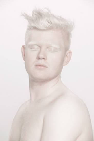 Albinizm Hastalığı Nedir