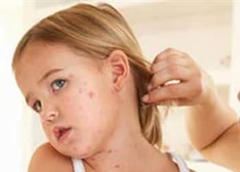 Alerji Çeşitleri Nelerdir