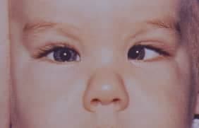 Ambliyopi (Görme Bozukluğu)