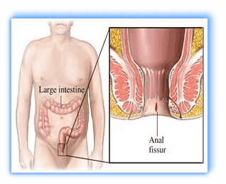 Anal Fissür (Makatta Çatlak)