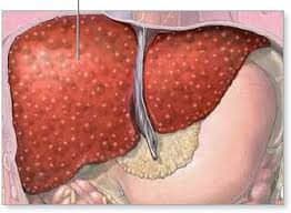 Bilier Atrezi Nedir?