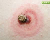 Böcek Isırığı Alerjisi