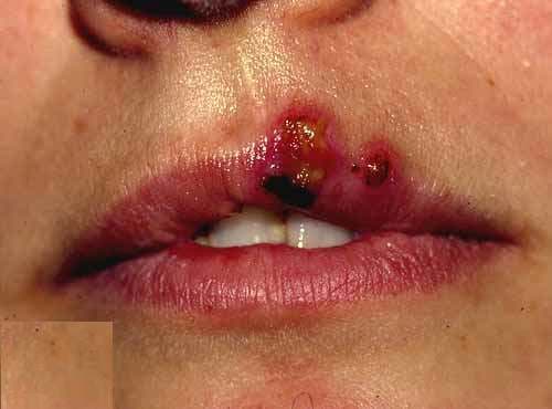 Herpes (Uçuk) Tedavisi