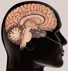 Hipofiz Tümörü Ameliyatı