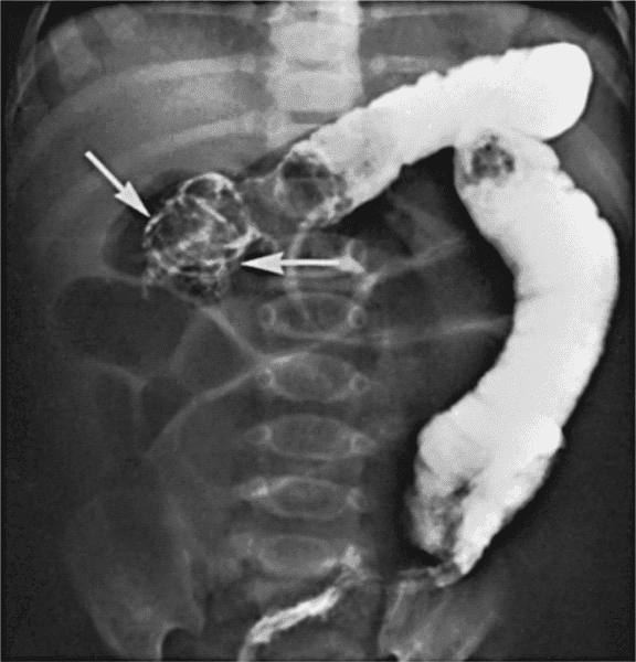 Hirschsprung Hastalığı Belirtileri