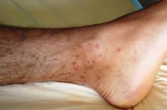 Churg Strauss Sendromu Nedir?