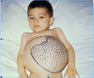 Dalak Büyümesi (Çocuk)