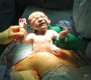 Sezeryan Doğum Nedir?