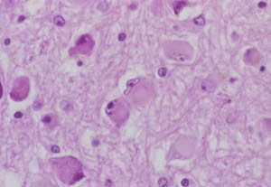 CMV Enfeksiyonu Nedir?