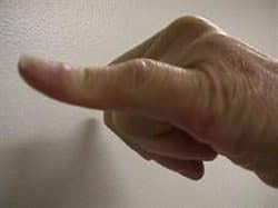 Düğme İliği Deformitesi Tedavisi