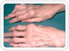 Romatoid Artrit (El)