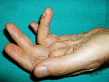 Dupuytren Kontraktürü Tedavisi