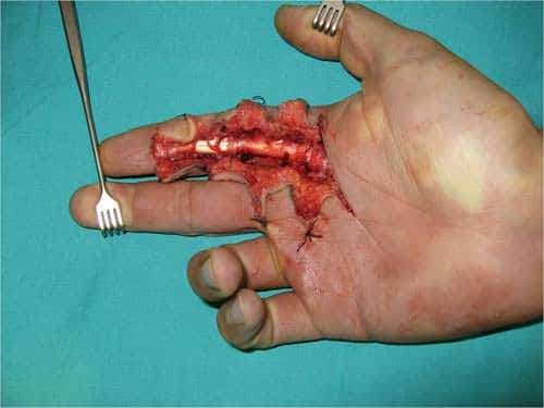 El Tümörleri Nelerdir?