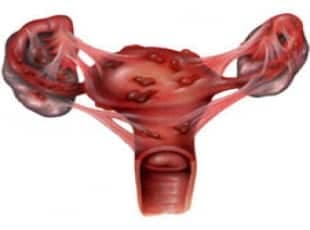 Endometriozis Hastalığı
