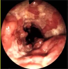 Enflamatuar Bağırsak Hastalığı Nedir?