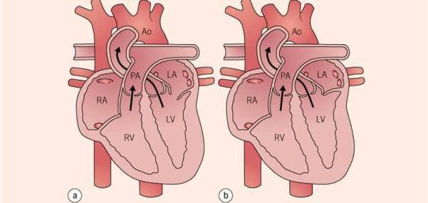 Kalp Kapak Hastalıkları Tedavisi