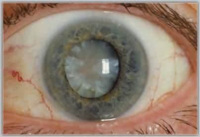 Katarakt Hastalığı  Sebepleri