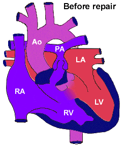 Fallot Tetralojisi Nedir?