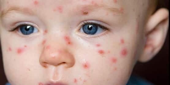 Kızamık Hastalığı