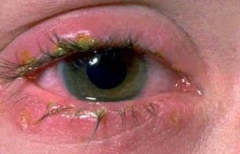 Konjonktivit Tedavisi