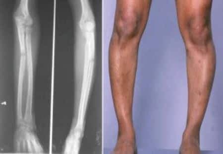 Raşitizm Hastalığı Tedavisi