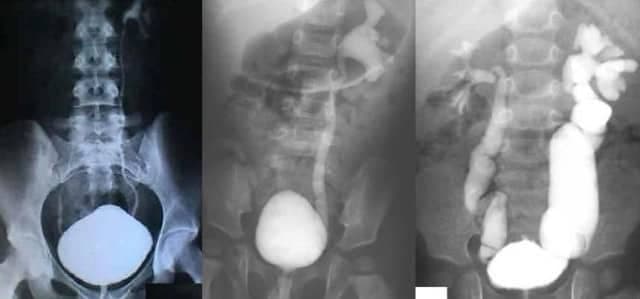 Veziko Üreteral Reflü Nedir?