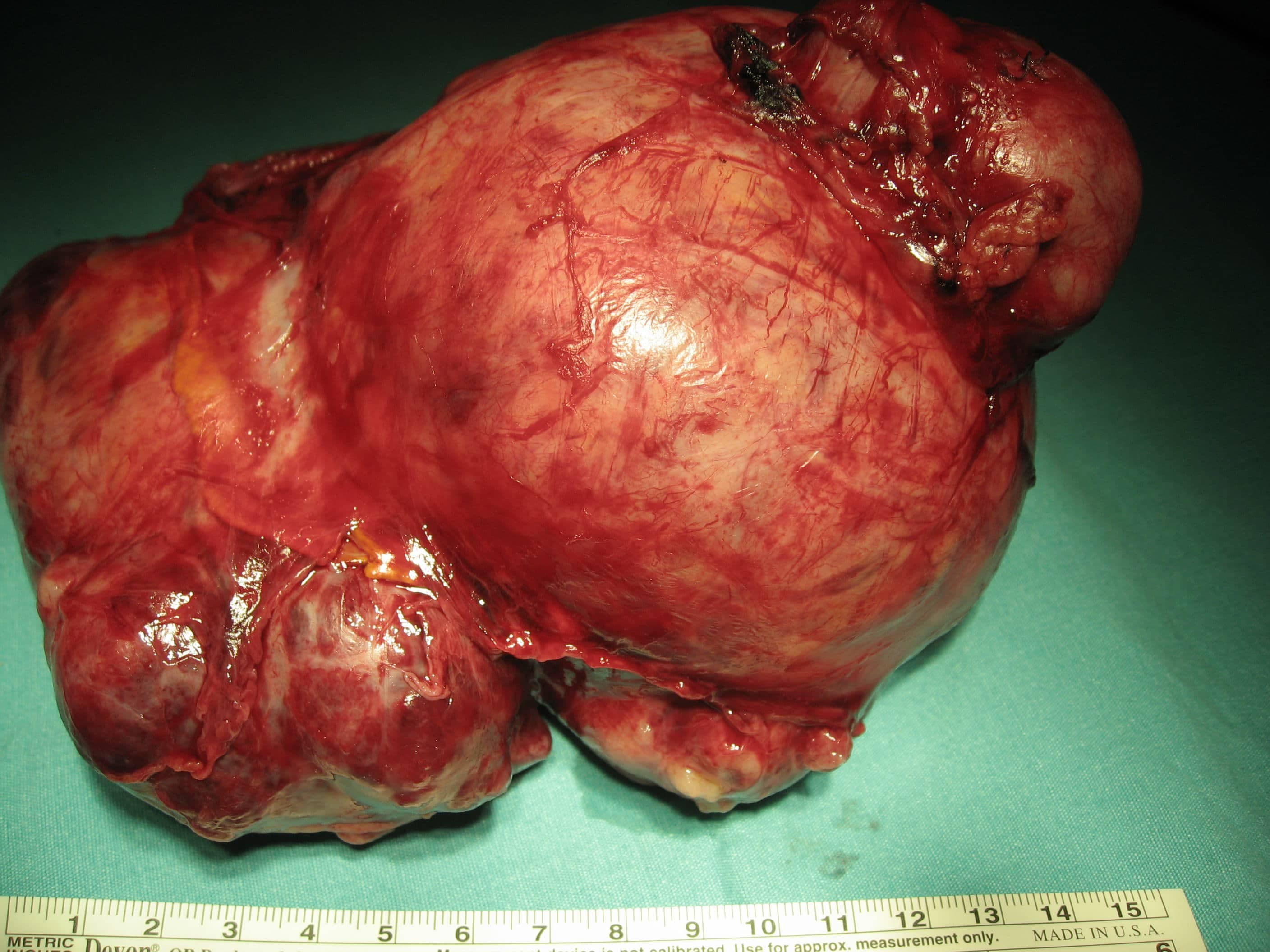 Wilms Tümörü Belirtileri Nelerdir?