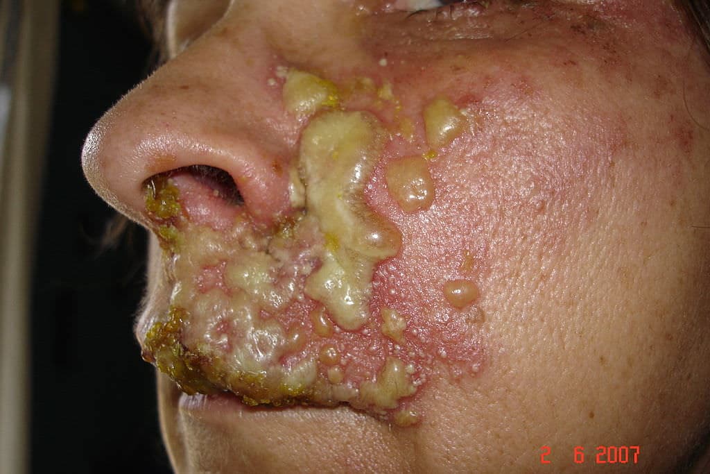 Zona Hastalığı Tedavisi