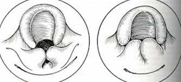 Laringomalazi Tedavisi