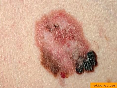 Melanom (Malign Melanom)