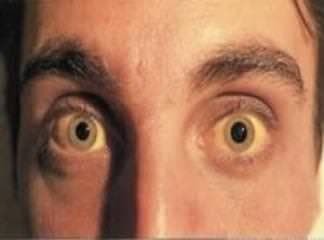 Obstrüktif Sarılık Bitkisel Tedavi