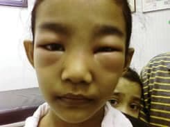 Nefrotik Sendrom – Çocuklarda