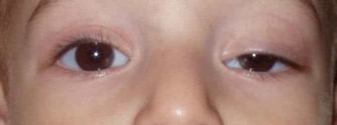 Pitozis (Blefaropitozis – Göz kapağı düşüklüğü)