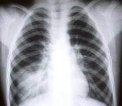 Pnömoni  ( Zatürre )