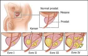 Prostat Kanseri