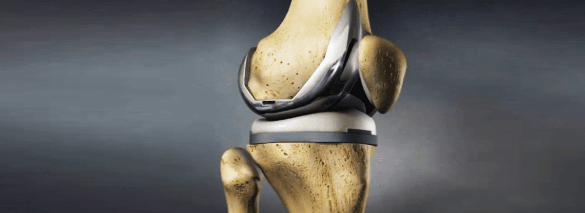 Diz Protezi Nedir
